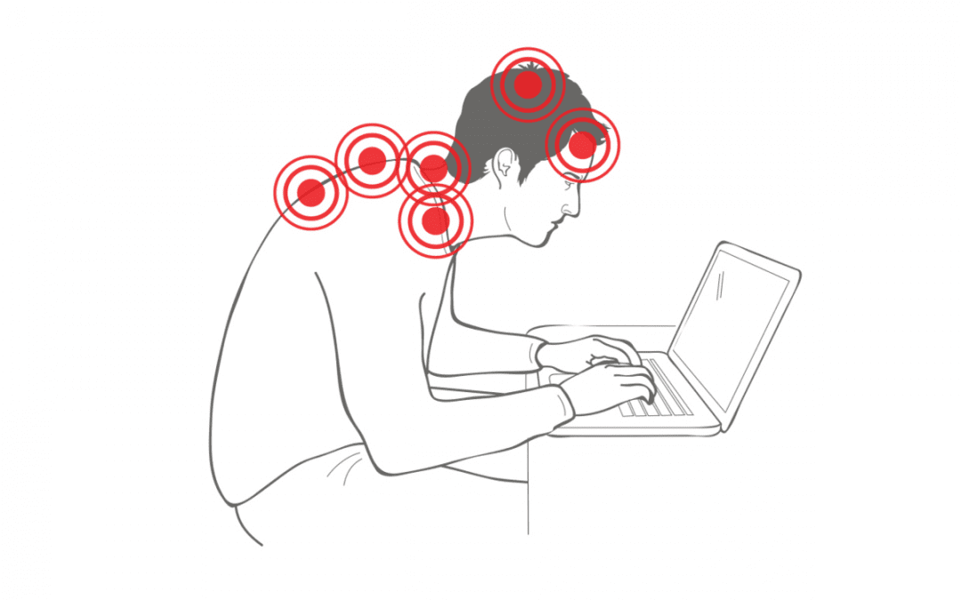 Tech Neck: How to Treat this Modern Problem